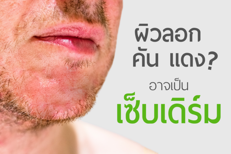 ผื่นแดงลอกเป็นขุยบริเวณคางจากเซ็บเดิร์ม (Seborrheic Dermatitis)